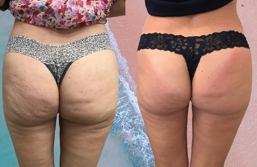 Emsculpt NEO Before and After Photo by Refresh Palm Beach Medical Aesthetics in Jupiter Florida