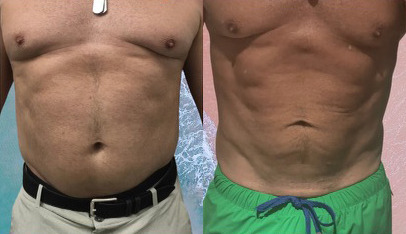 Emsculpt NEO Before and After Photo by Refresh Palm Beach Medical Aesthetics in Jupiter Florida