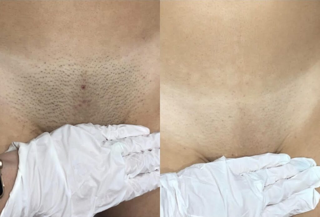 Hair Removal Before and After Photo by Refresh Palm Beach Medical Aesthetics in Jupiter Florida