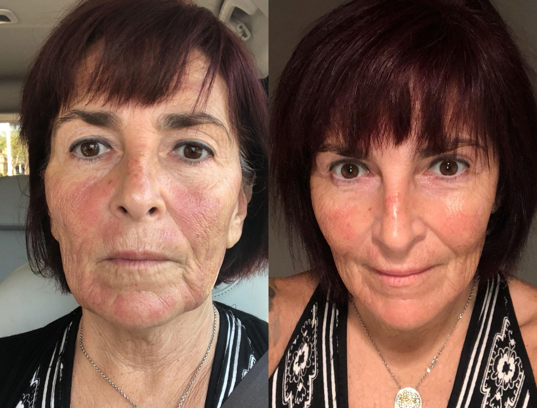 Photofacial Before and After Photo by Refresh Palm Beach Medical Aesthetics in Jupiter Florida