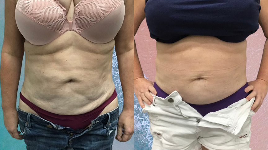 UltraShape Before and After Photo by Refresh Palm Beach Medical Aesthetics in Jupiter Florida