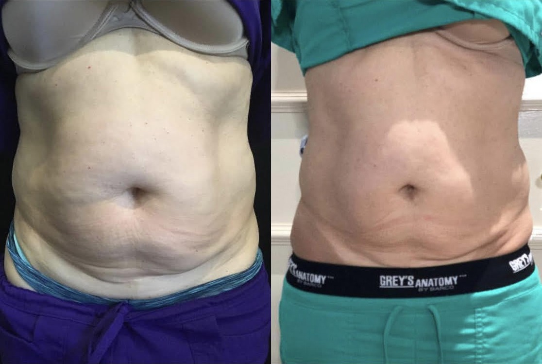 UltraShape Before and After Photo by Refresh Palm Beach Medical Aesthetics in Jupiter Florida