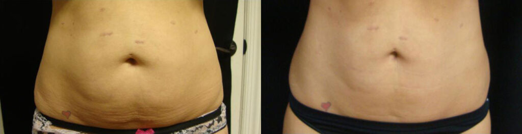 VelaShape III Before and After Photo by Refresh Palm Beach Medical Aesthetics in Jupiter Florida