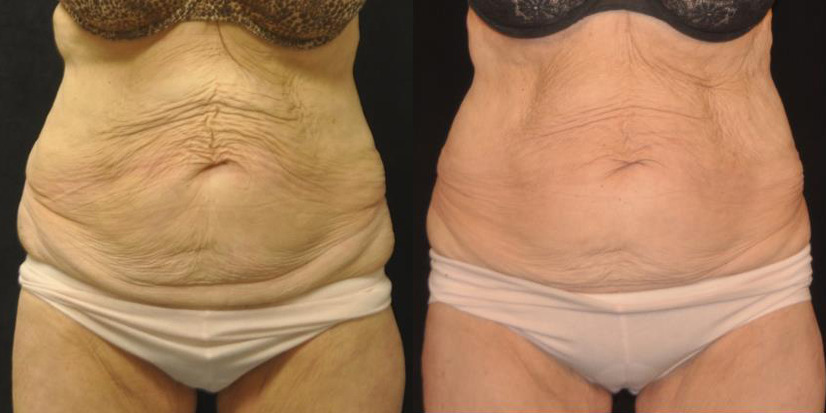 VelaShape III Before and After Photo by Refresh Palm Beach Medical Aesthetics in Jupiter Florida