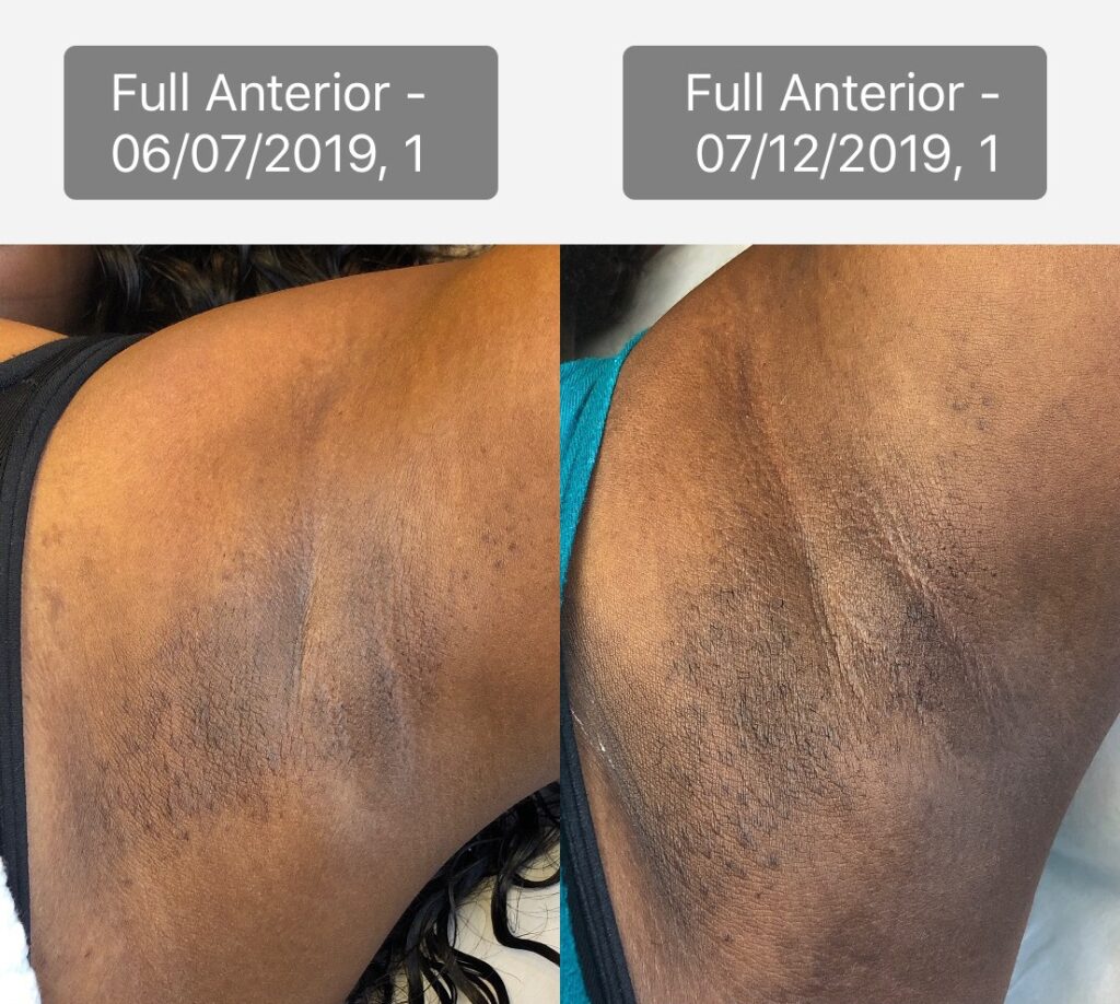 VI Peel Treatment Before and After Photo by Refresh Palm Beach Medical Aesthetics in Jupiter Florida