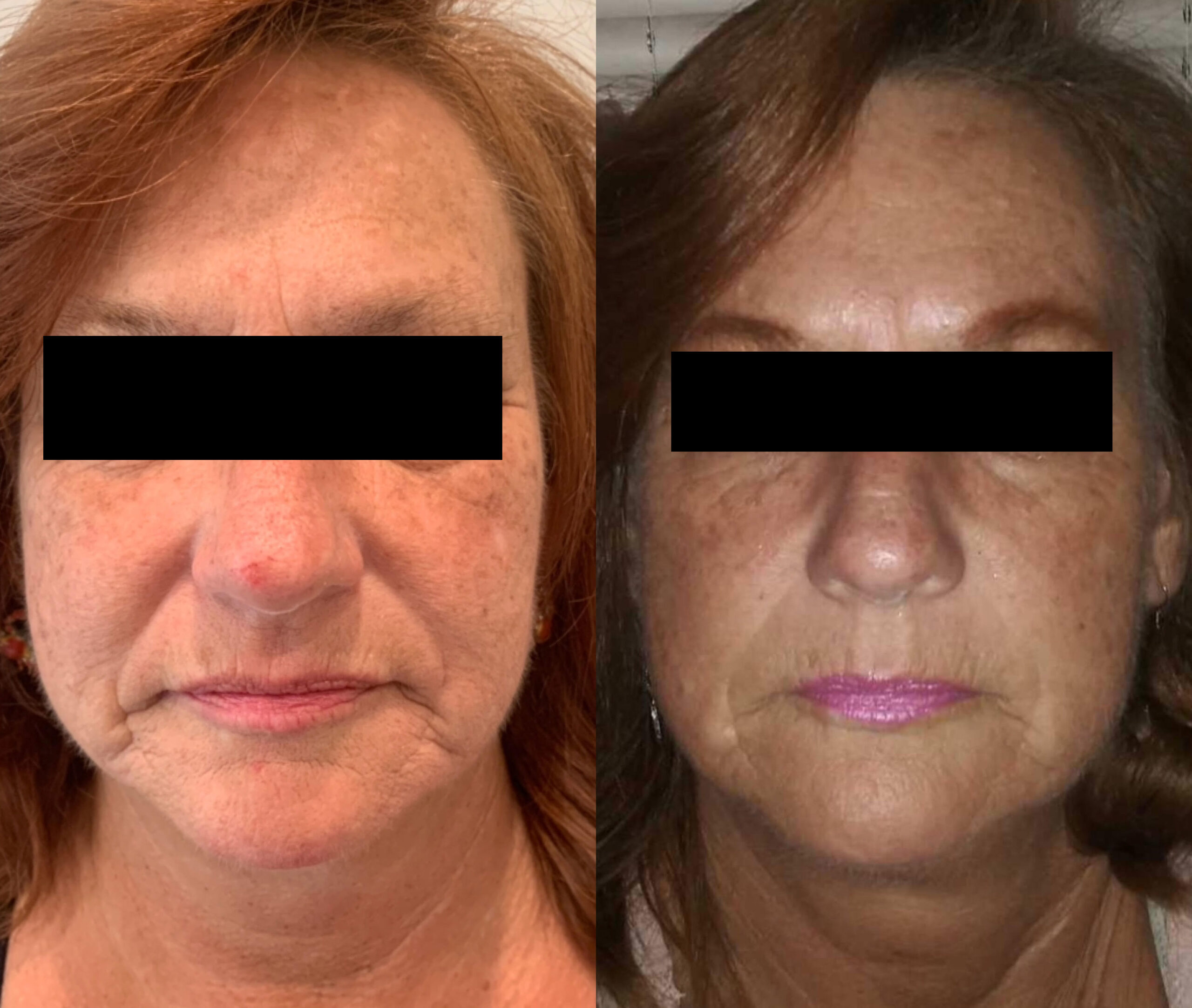 microneedling before after