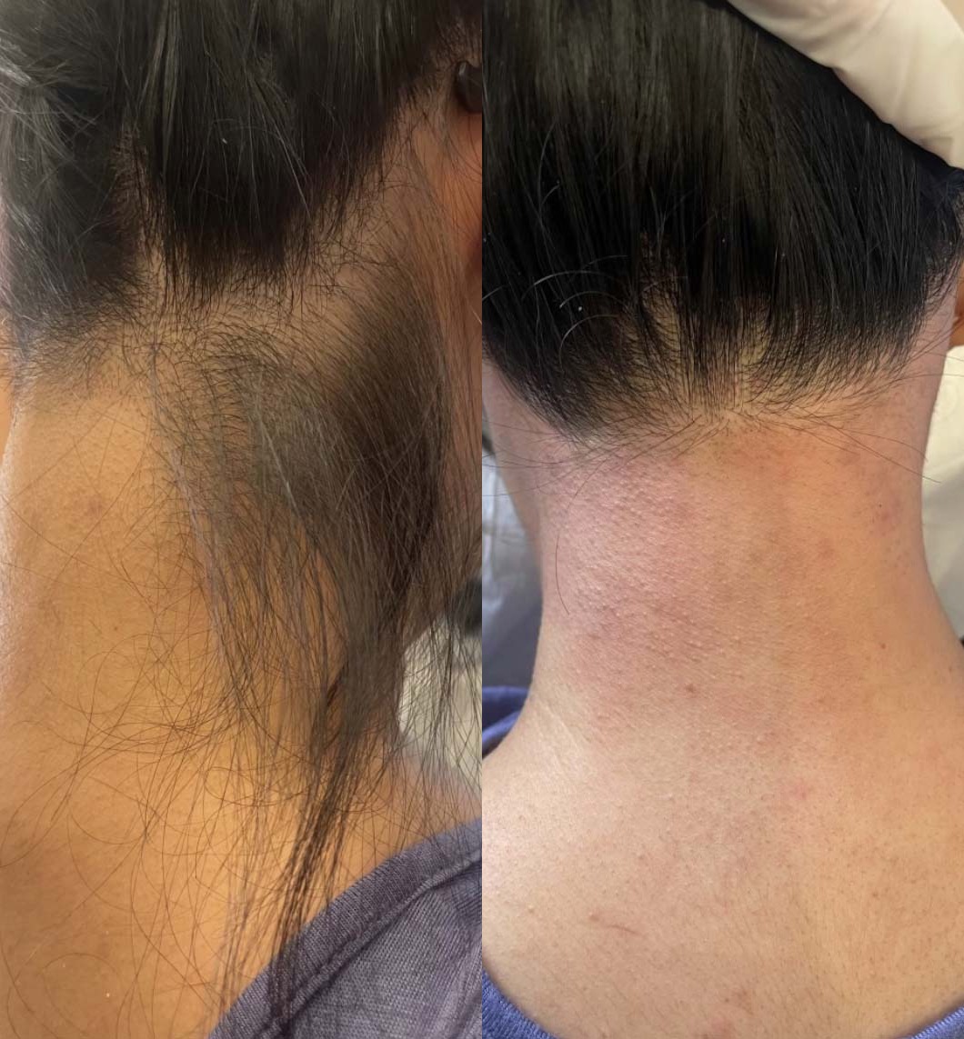 Laser hair removal Before and After Photo by Refresh Palm Beach Medical Aesthetics in Jupiter Florida