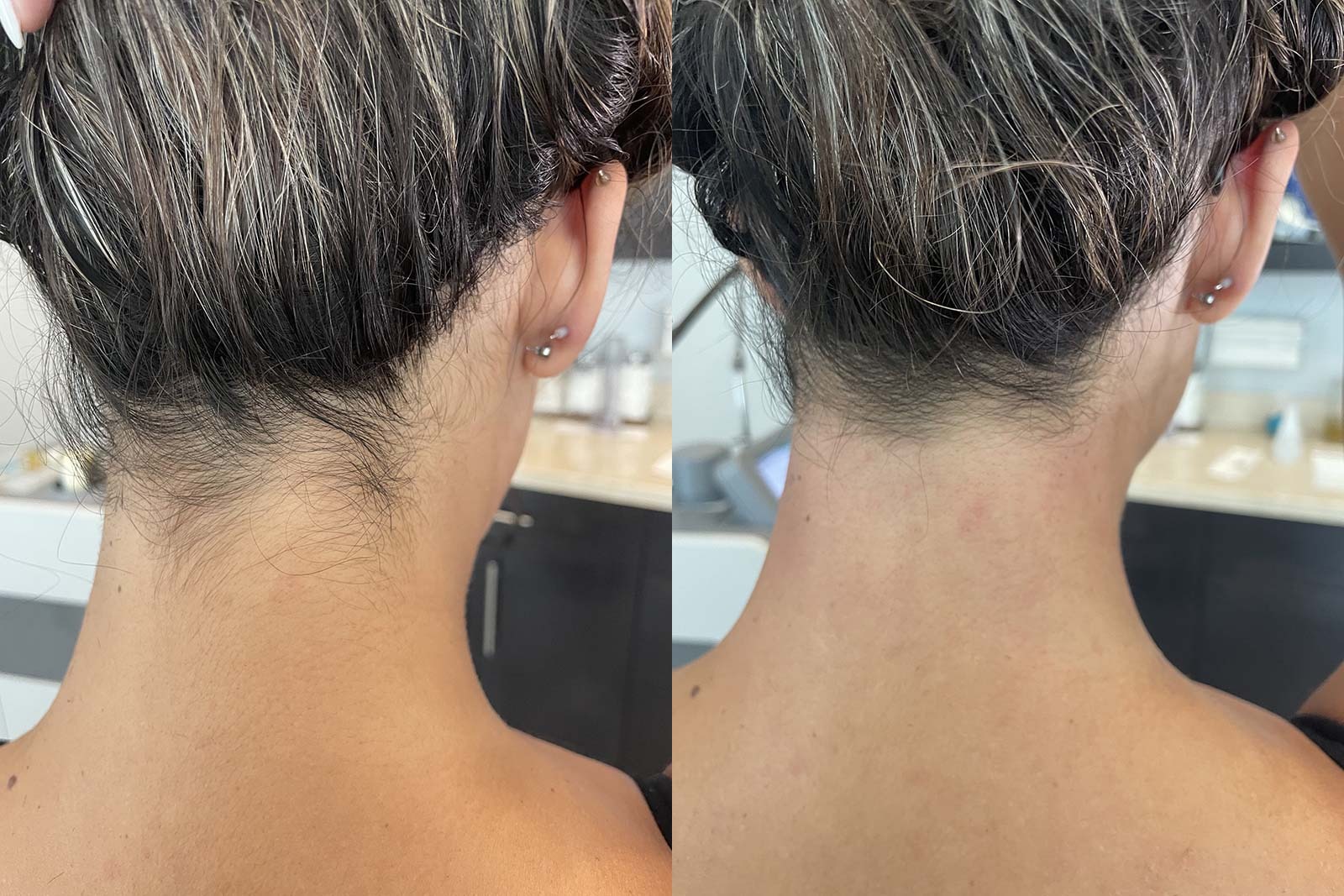 Laser hair removal Before and After Photo by Refresh Palm Beach Medical Aesthetics in Jupiter Florida