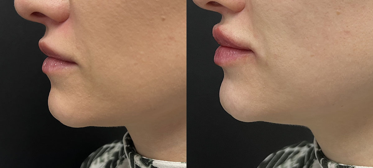 Lip filler Before and After Photo by Refresh Palm Beach Medical Aesthetics in Jupiter Florida