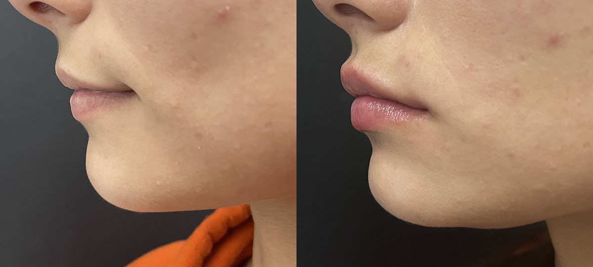 Lip filler Before and After Photo by Refresh Palm Beach Medical Aesthetics in Jupiter Florida