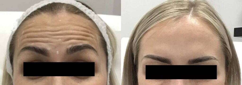 Botox Before and After Photo by Refresh Palm Beach Medical Aesthetics in Jupiter Florida
