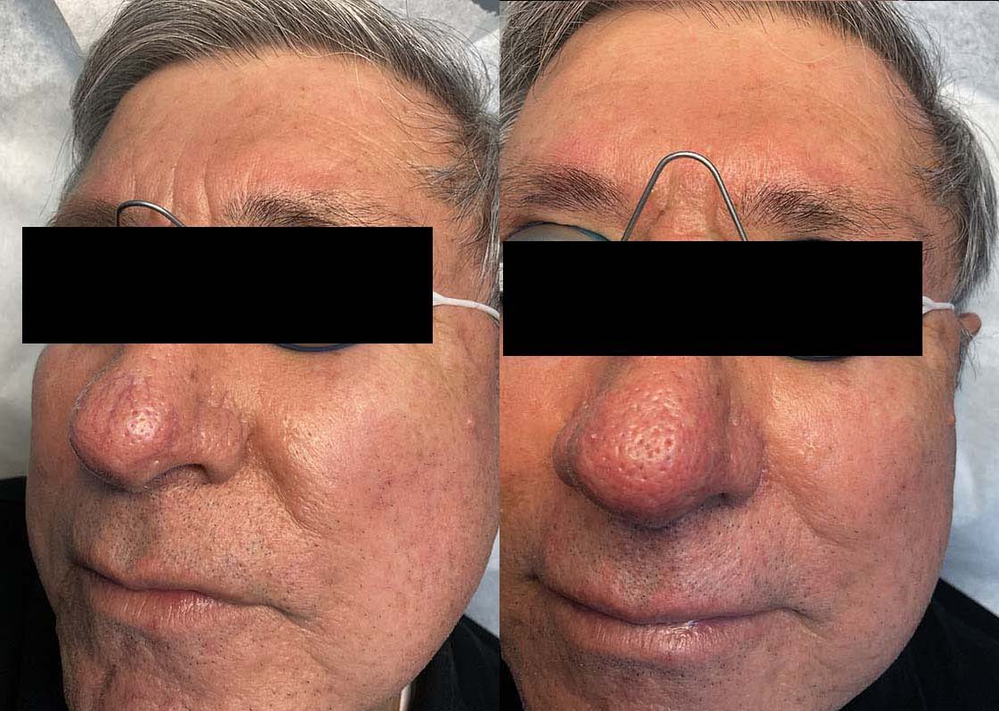 Broken Capillaries Before and After Photo by Refresh Palm Beach Medical Aesthetics in Jupiter Florida