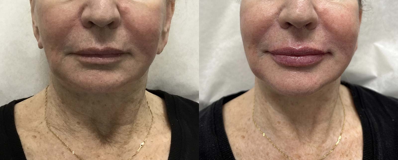 Chin Augmentation Before and After Photo by Refresh Palm Beach Medical Aesthetics in Jupiter Florida