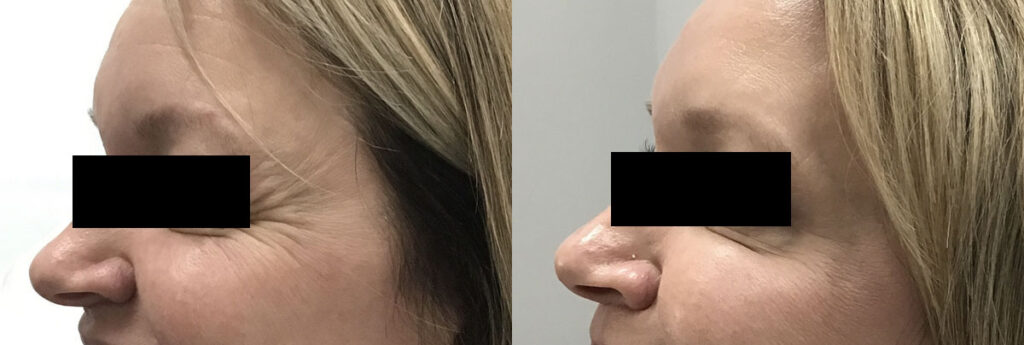 Crow's Feet Before and After Photo by Refresh Palm Beach Medical Aesthetics in Jupiter Florida