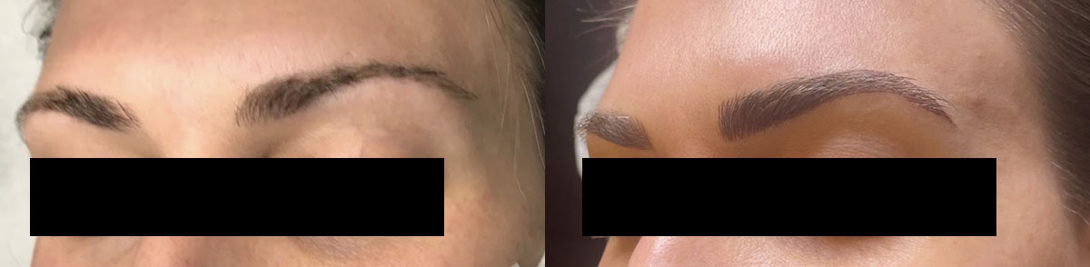 Microblading Before and After Photo by Refresh Palm Beach Medical Aesthetics in Jupiter Florida
