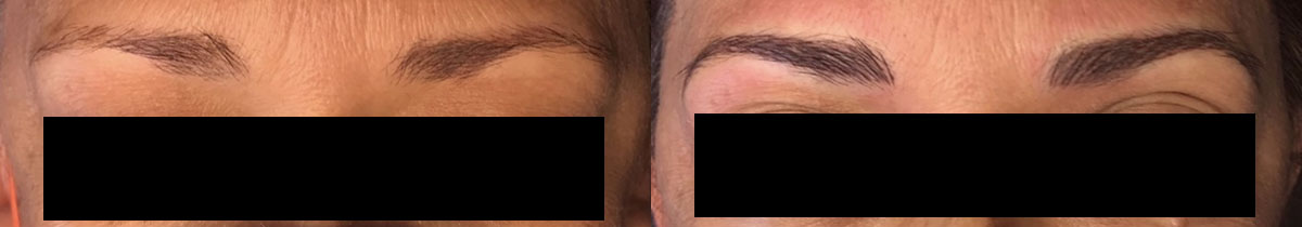 Microblading Before and After Photo by Refresh Palm Beach Medical Aesthetics in Jupiter Florida