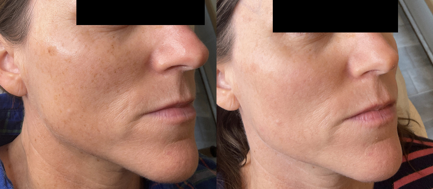 Photofacial Before and After Photo by Refresh Palm Beach Medical Aesthetics in Jupiter Florida