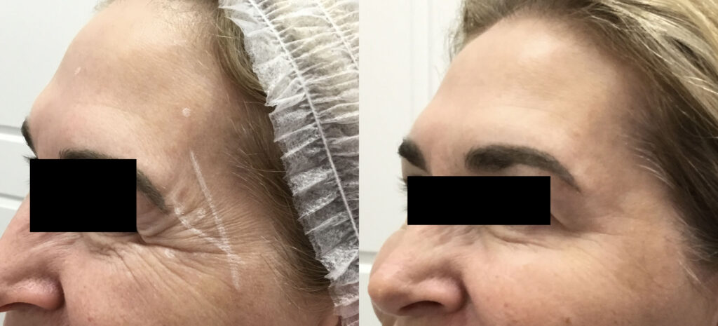 Crow's Feet Before and After Photo by Refresh Palm Beach Medical Aesthetics in Jupiter Florida