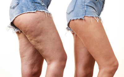 How to Get Rid of Cellulite —And Why EMTONE Is the Best at It