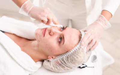 Acne Scarring Treatment Options for You