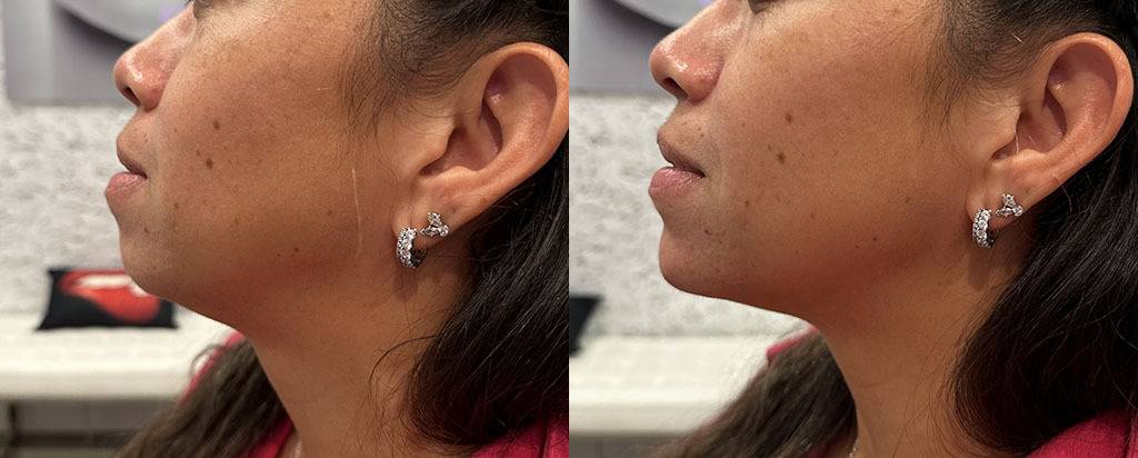 Chin Augmentation Before and After by Refresh Palm Beach Medical Aesthetics in Jupiter, FL