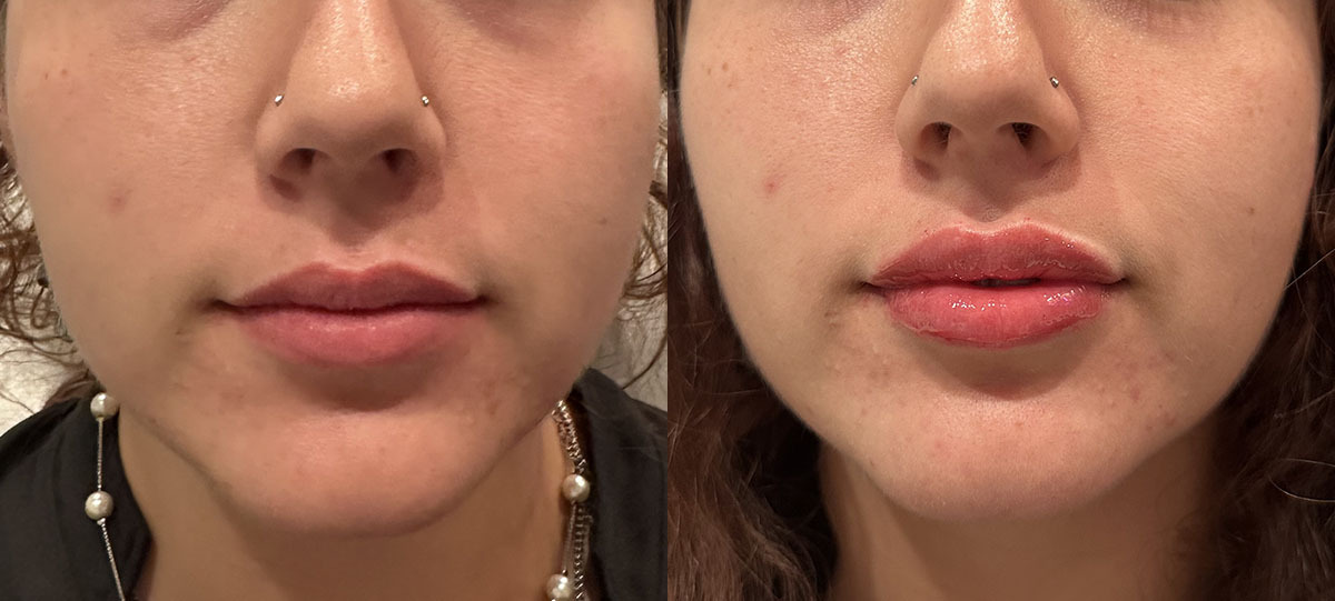 Lip Filler Before and After by Refresh Palm Beach Medical Aesthetics