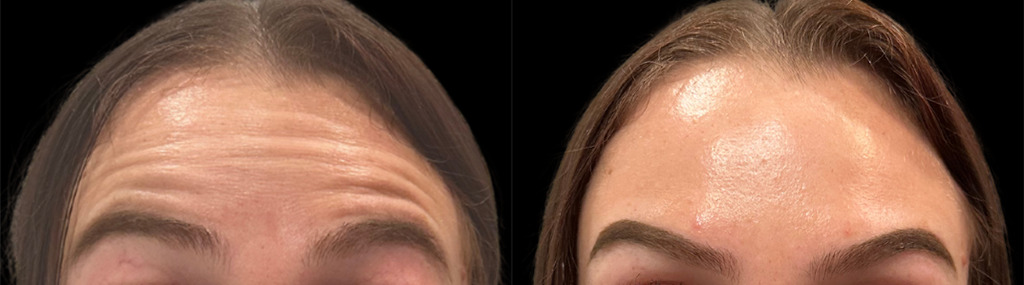 Botox Before and After by Refresh Palm Beach Medical Aesthetics in Jupiter, FL